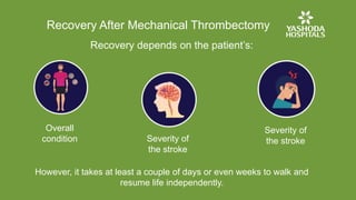 Mechanical Thrombectomy for Acute Ischemic Stroke | Brain Stroke ...