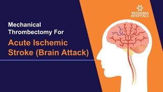 Mechanical
Thrombectomy For
Acute Ischemic
Stroke (Brain Attack)
 