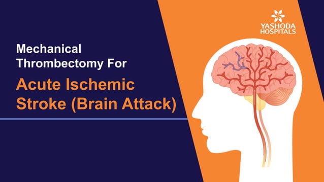 Mechanical Thrombectomy For Acute Stroke Relief | PPT
