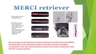 Mechanical thrombectomy in acute stroke [Autosaved].pptx