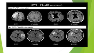Mechanical thrombectomy in acute stroke [Autosaved].pptx