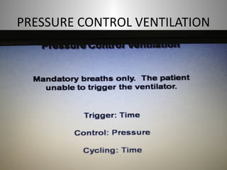 PRESSURE CONTROL VENTILATION 
 