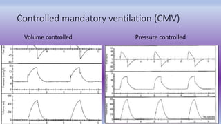 Mechanical Ventilation.pptx