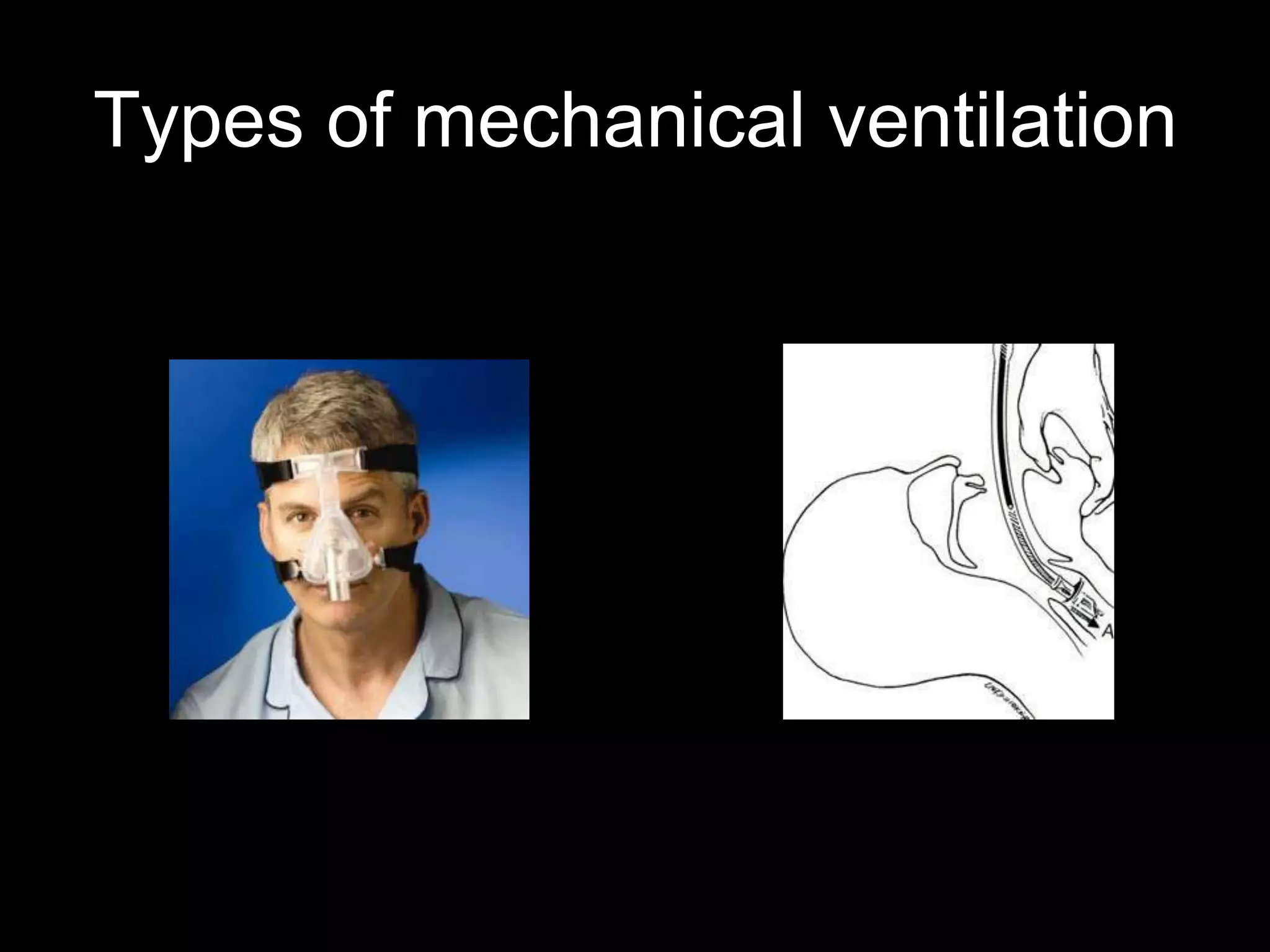 Types of mechanical ventilation
 