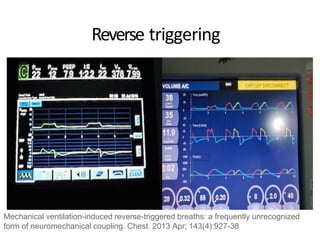 Reverse triggering
Mechanical ventilation-induced reverse-triggered breaths: a frequently unrecognized
form of neuromechanical coupling. Chest. 2013 Apr; 143(4):927-38
 
