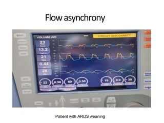 Flowasynchrony
Patient with ARDS weaning
 