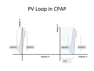 PV Loop in CPAP
 