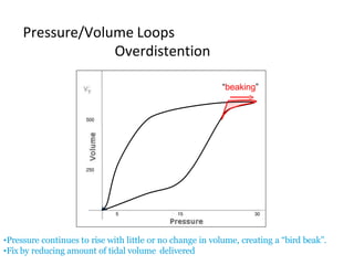 15 305
Pressure/Volume Loops
Overdistention
“beaking”
•Pressure continues to rise with little or no change in volume, creating a “bird beak”.
•Fix by reducing amount of tidal volume delivered
500
250
 