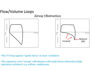 0
Reduced
PEF“scooping”
Flow/Volume Loops
•The F-V loop appears “upside down” on most ventilators.
•The expiratory curve “scoops” with diseases with small airway obstruction (high
expiratory resistance). e.g. asthma, emphysema.
Airway Obstruction
 