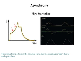 Asynchrony
Flow Starvation
•The inspiratory portion of the pressure wave shows a scooping or “dip”, due to
inadequate flow.
 