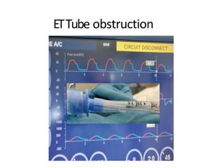 ETTube obstruction
 