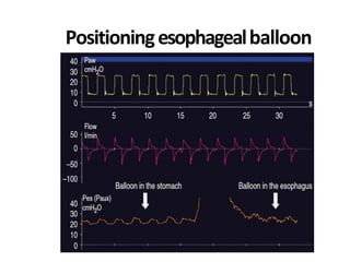Positioningesophagealballoon
 