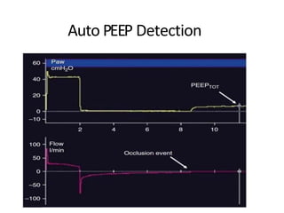 Auto PEEP Detection
 