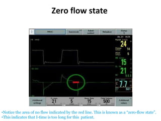 •Notice the area of no flow indicated by the red line. This is known as a “zero-flow state”.
•This indicates that I-time is too long for this patient.
Zero flow state
 
