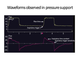 Waveformsobservedin pressuresupport
 