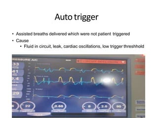 Autotrigger
• Assisted breaths delivered which were not patient triggered
• Cause
• Fluid in circuit, leak, cardiac oscillations, low trigger threshhold
 