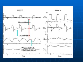 Missed breath Auto PEEP Wasted effort, increased WOB 