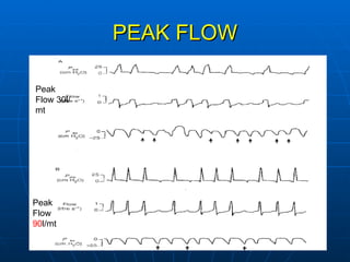 PEAK FLOW Peak Flow 30l/mt Peak Flow  90 l/mt 
