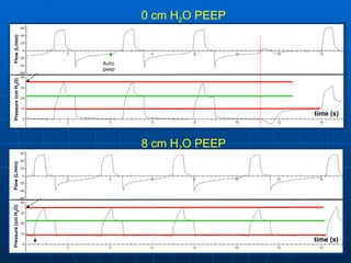 0 cm H 2 O PEEP 8 cm H 2 O PEEP Auto peep 