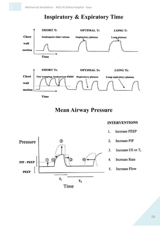 16
Mechanical Ventilation - NICU Al Shifaa Hospital - Gaza
Neonatal Respiratory Physiology
Time Constant:
An index of how rapidly the lungs can empty.
Time constant = Compliance X Resistance
 In BPD time constant is long because of ↑ resistance.
 In RDS time constant is short because of low compliance.
 Normal = 0.12-0.15 sec.
Time Constant
Inspiratory time must be 3-5 X time constant
 One time constant = time for alveoli to discharge 63% of its
volume through the airway.
 Two time constant = 84% of the volume leaves.
 Three time constant = 95% of volume leaves.
In RDS : require a longer Inspiratory time because the lung will empty
rapidly but require more time to fill.
In CLD : decrease vent rate, which allows lengthening the I time and E
time.
 
