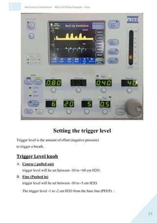 23
Mechanical Ventilation - NICU Al Shifaa Hospital - Gaza
The Breeze operates in six basic modes :
Volume control
 A/C + SIGH
 A/C
 SIMV
 Spontaneous
Pressure Control
 Spontaneous.
 SIMV
 A/C
In neonates we use the pressure control mode.
Controls:
FIO2 0.21-1.0 ±3%
Flow 3 -120 L/min
Insp. Time 0.1 – 3.0 sec
Rate 1 – 150 bpm.
Tidal volume 10 – 2000 ml.
PIP 0 – 60 cm H2O
PEEP/CPAP 0 – 60 cm H2O.
Spont. Flow 0 – 50 L/mint.
Trigger Level -10 – +60 cmH2O
 