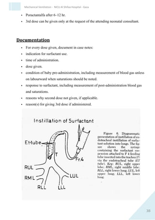 38
Mechanical Ventilation - NICU Al Shifaa Hospital - Gaza
Indication
Prophylaxis (administration within 15 min of birth)
Babies born ≤26 weeks gestation
 Electively intubate and give surfactant as prophylaxis Babies born
at 27–28+6 weeks’ gestation
 If require intubation for respiratory support during
resuscitation/stabilisation, give surfactant as prophylaxis
Early rescue treatment
Babies born at 27–28+6 weeks’ gestation
 If require intubation for respiratory distress, give surfactant early
(within 2 hr of birth)
All other babies requiring intubation and needing FiO2 >0.3 for
surfactant deficiency
disease i.e. continuing respiratory distress AND evidence of RDS on
chest X-ray
 Give rescue surfactant
Other babies that can be considered for surfactant therapy (after senior
discussion)
 Ventilated babies with meconium aspiration syndrome
 Term babies with pneumonia and stiff lungs
Contraindication
Discuss use in babies with massive pulmonary haemorrhage with
neonatal consultant.
Equipment
 Natural surfactant, Poractantalfa (Infasurf) 6 ml each ml
contain 35 mg dose 3ml /kg.
 