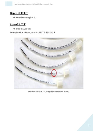 7
Mechanical Ventilation - NICU Al Shifaa Hospital - Gaza
Intubation failure
Definition: Unable to intubate within 30 seconds
 If intubation unsuccessful, seek help from someone more experienced.
 If there is a risk of aspiration, maintain cricoid pressure.
 Continue bag and mask ventilation with 100% oxygen until successful
intubation achieved.
Depth of E.T.T
 Insertion = weigh + 6 .
Size of E.T.T
 1/10 G.A in wks .
Example : G.A 35 wks , so size of E.T.T 35/10=3.5
Different size of E.T.T. I.D (Internal Diameter in mm)
 