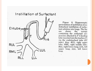 mechanicalventilationinneonates-140329120532-phpapp01.pdf