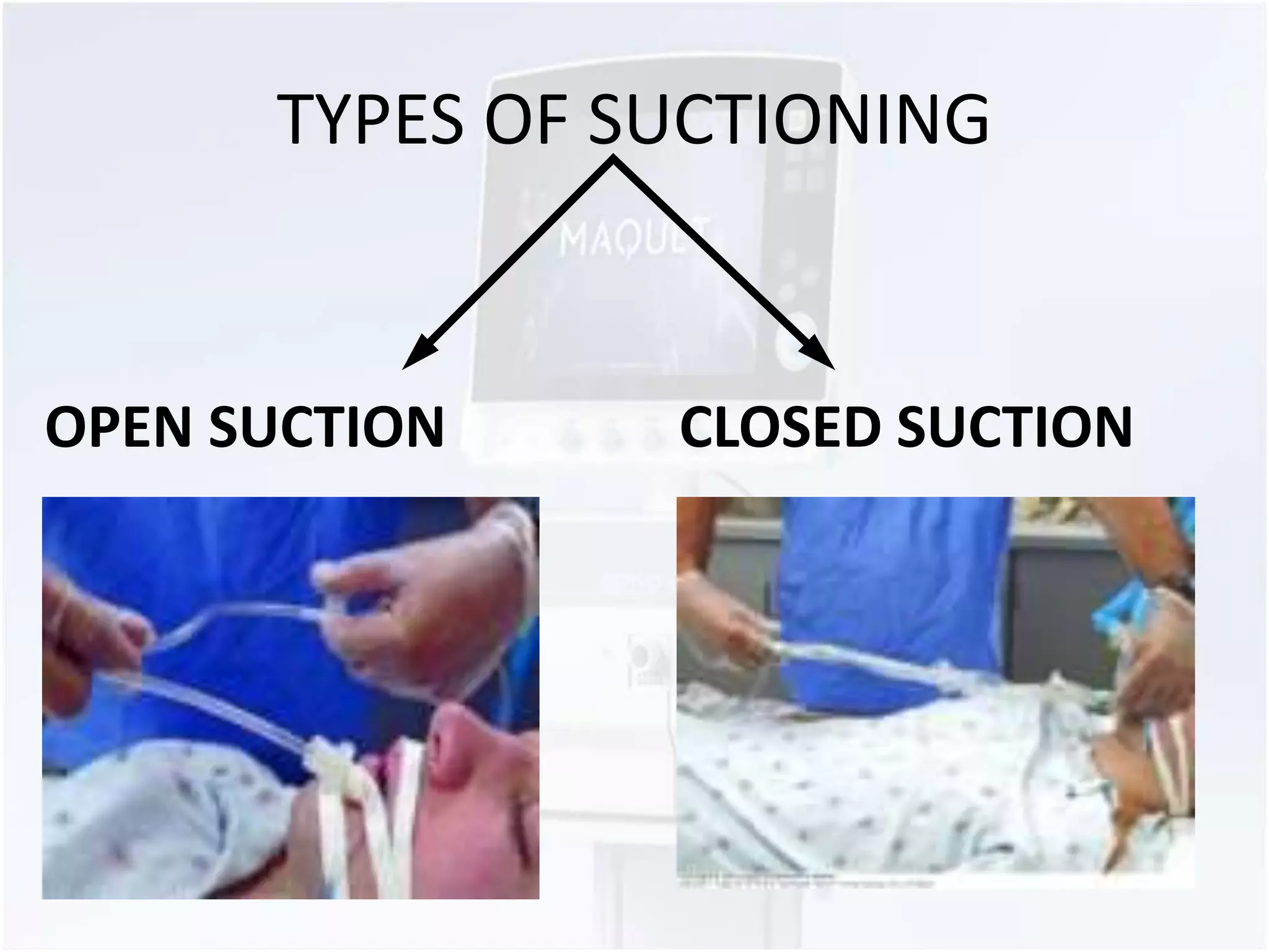 TYPES OF SUCTIONING 
OPEN SUCTION CLOSED SUCTION 
 