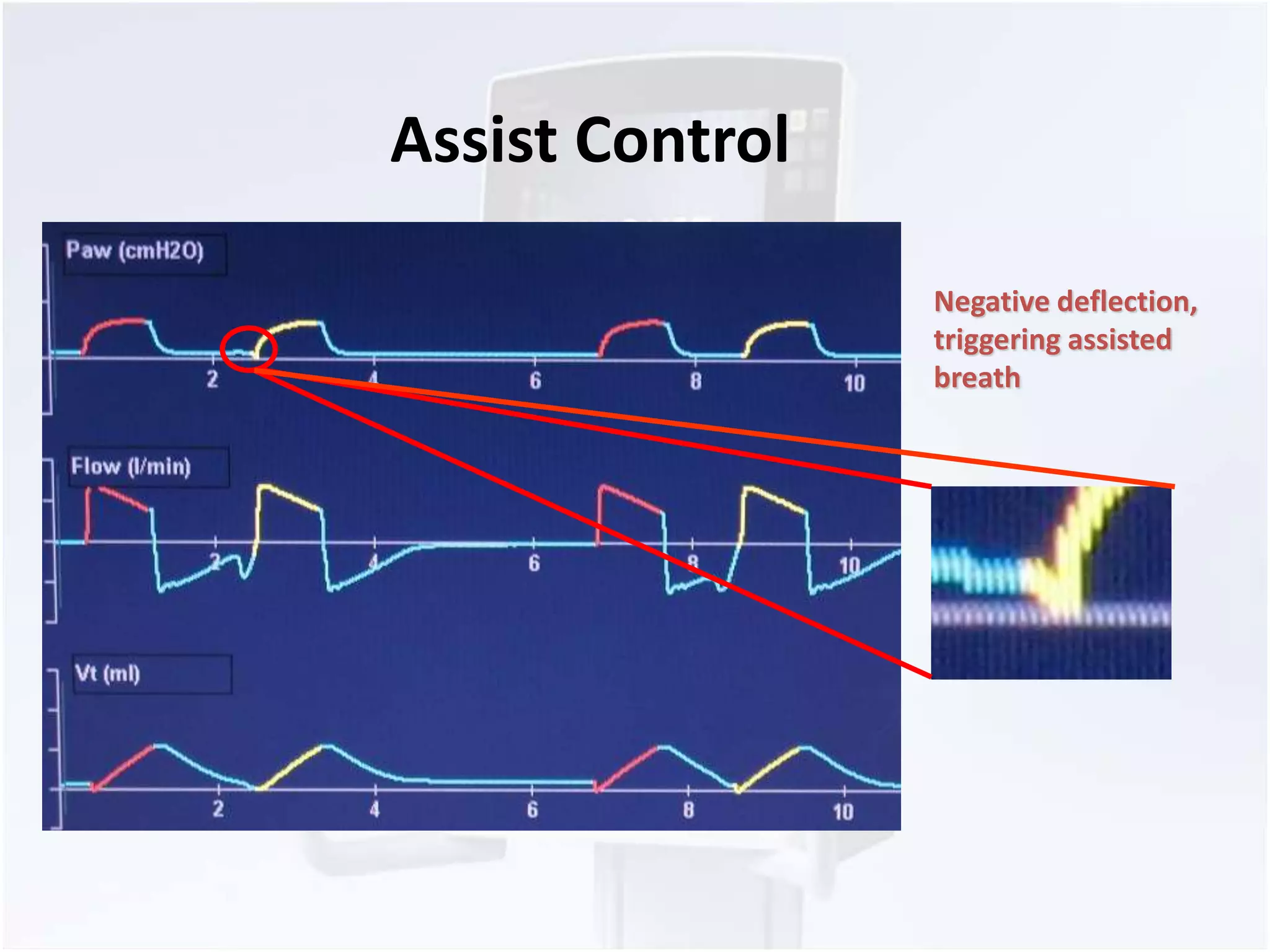 Negative deflection, 
triggering assisted 
breath 
Assist Control 
 