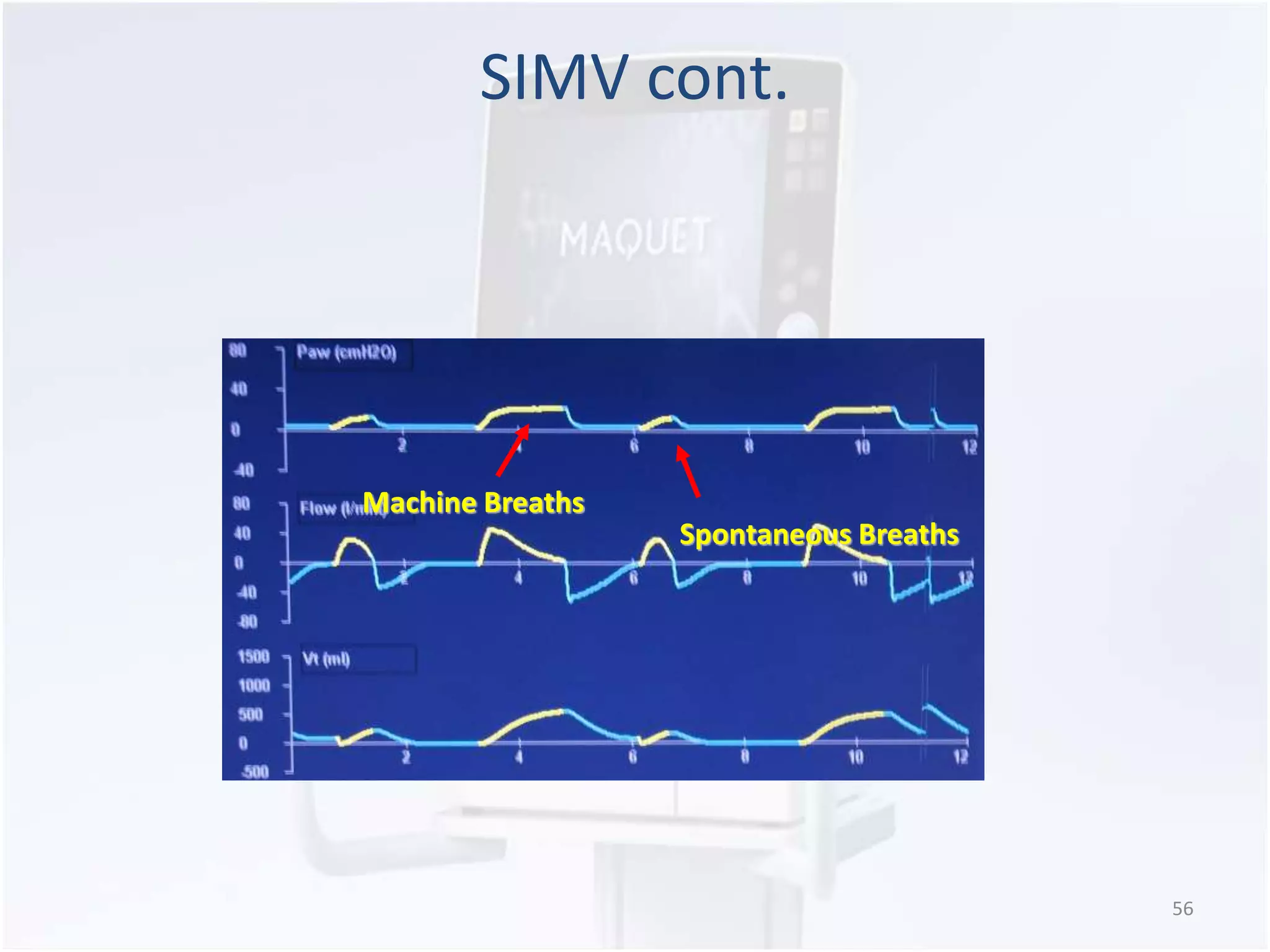 SIMV cont. 
56 
Machine Breaths 
Spontaneous Breaths 
 