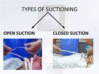 TYPES OF SUCTIONING 
OPEN SUCTION CLOSED SUCTION 
 