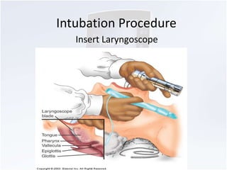 Intubation Procedure 
Insert Laryngoscope 
 