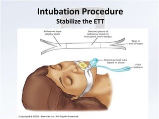 Intubation Procedure 
Stabilize the ETT 
 