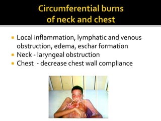 Mechanical ventilation, sedation and analgesia in pediatric burns | PPTX