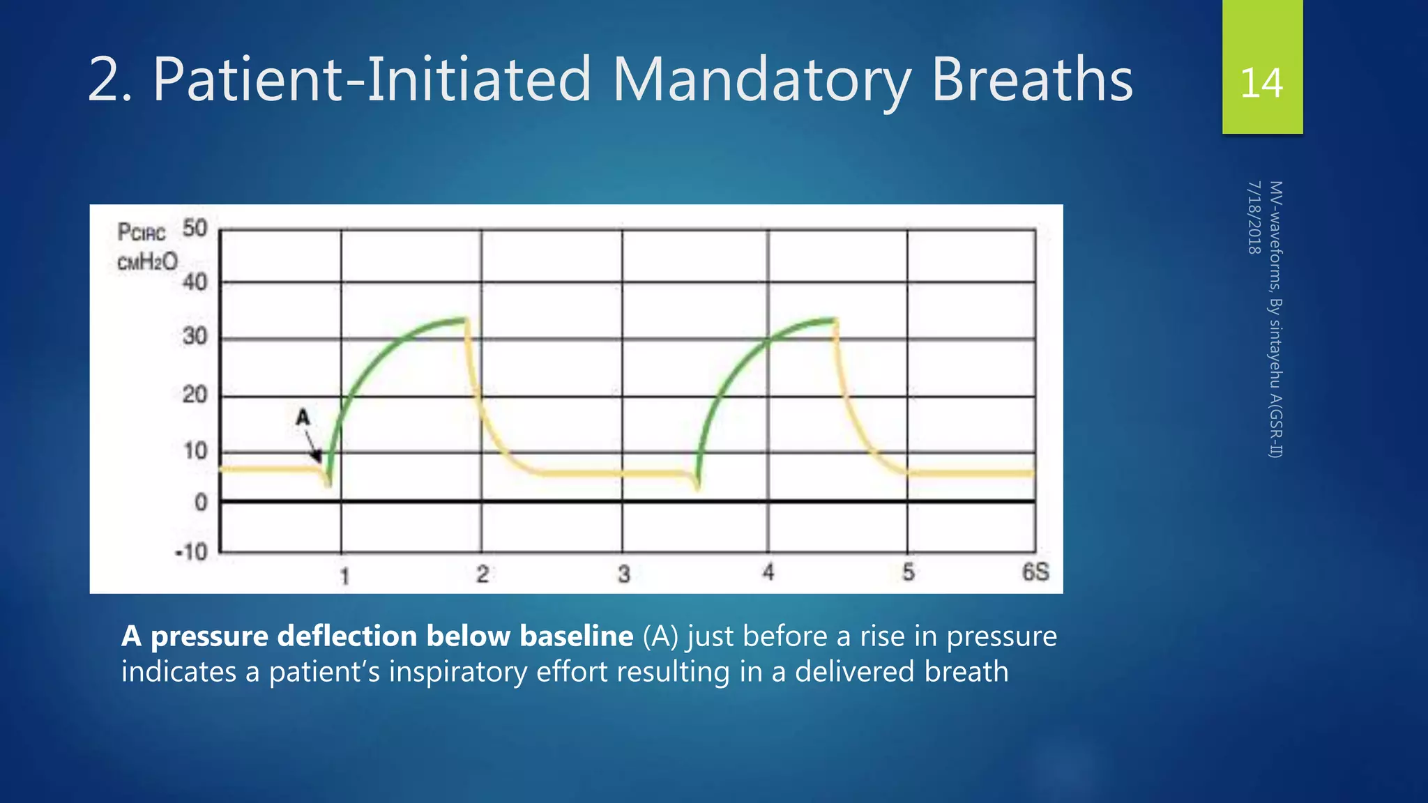 2. Patient-Initiated Mandatory Breaths 14
A pressure deflection below baseline (A) just before a rise in pressure
indicates a patient’s inspiratory effort resulting in a delivered breath
 