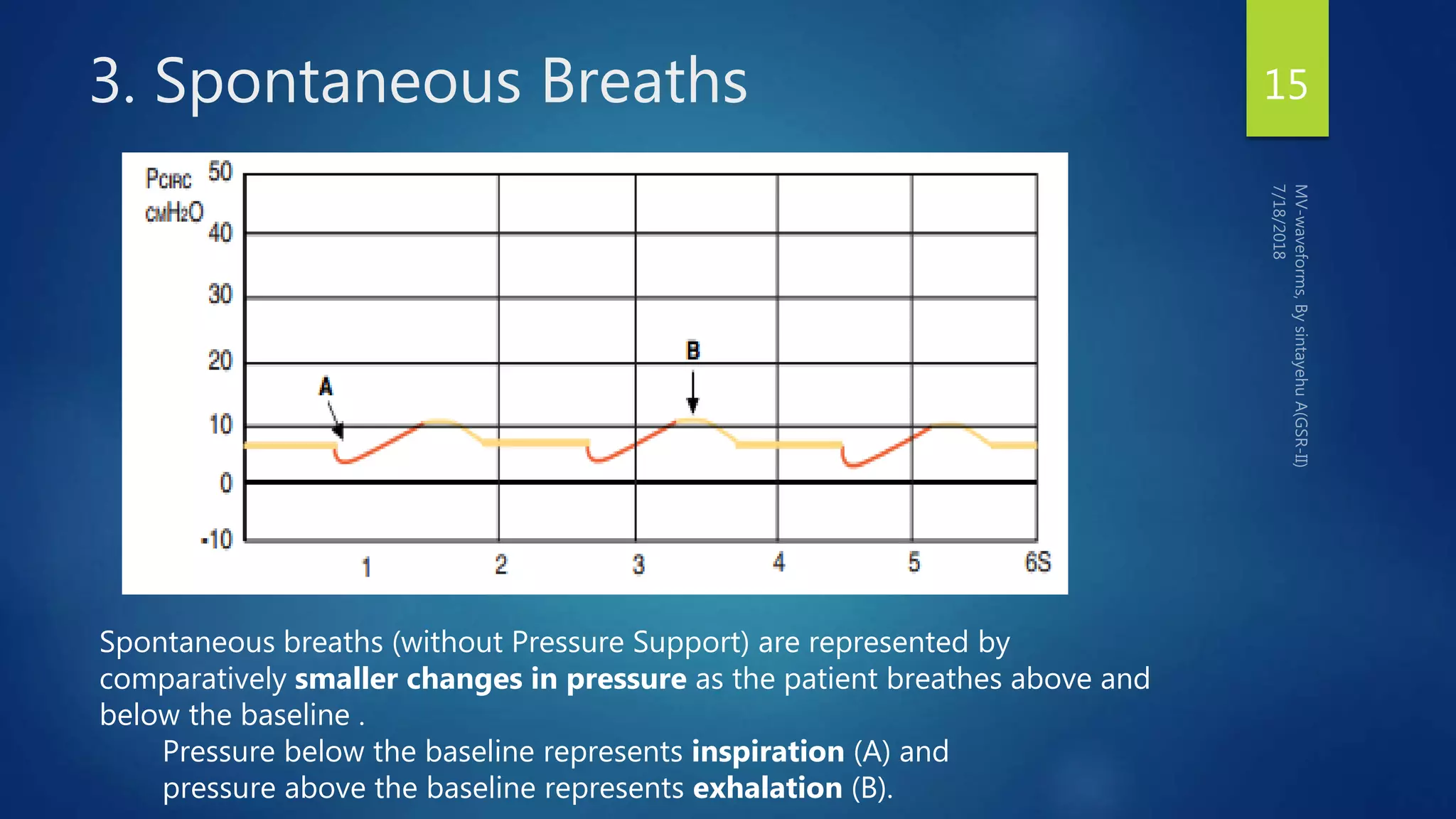 3. Spontaneous Breaths 15
Spontaneous breaths (without Pressure Support) are represented by
comparatively smaller changes in pressure as the patient breathes above and
below the baseline .
Pressure below the baseline represents inspiration (A) and
pressure above the baseline represents exhalation (B).
 