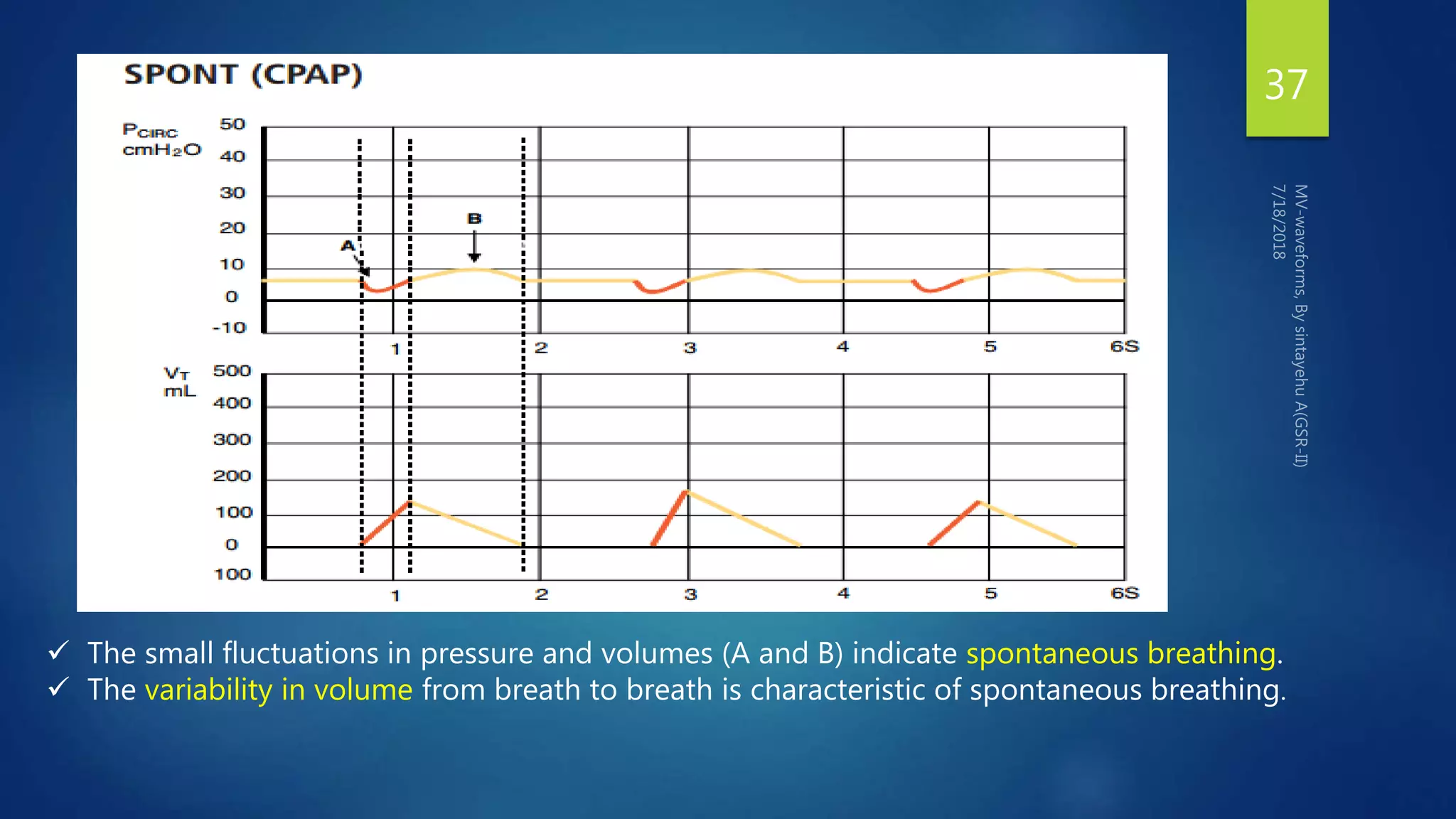 37
 The small fluctuations in pressure and volumes (A and B) indicate spontaneous breathing.
 The variability in volume from breath to breath is characteristic of spontaneous breathing.
 
