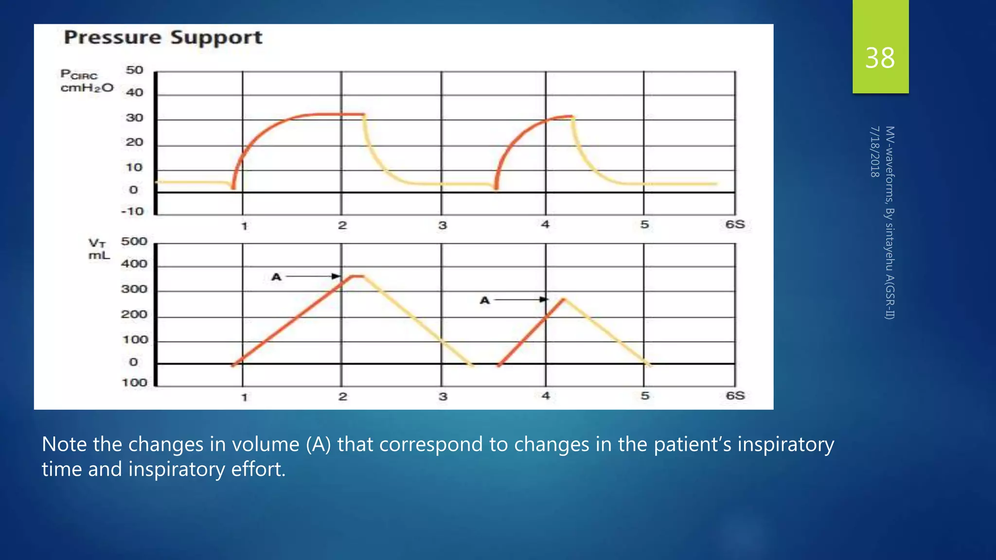 38
Note the changes in volume (A) that correspond to changes in the patient’s inspiratory
time and inspiratory effort.
 