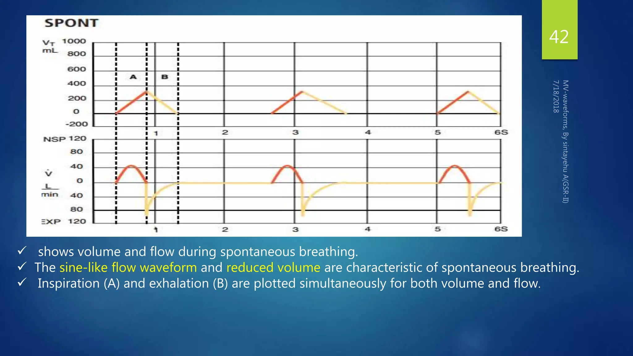 42
 shows volume and flow during spontaneous breathing.
 The sine-like flow waveform and reduced volume are characteristic of spontaneous breathing.
 Inspiration (A) and exhalation (B) are plotted simultaneously for both volume and flow.
 