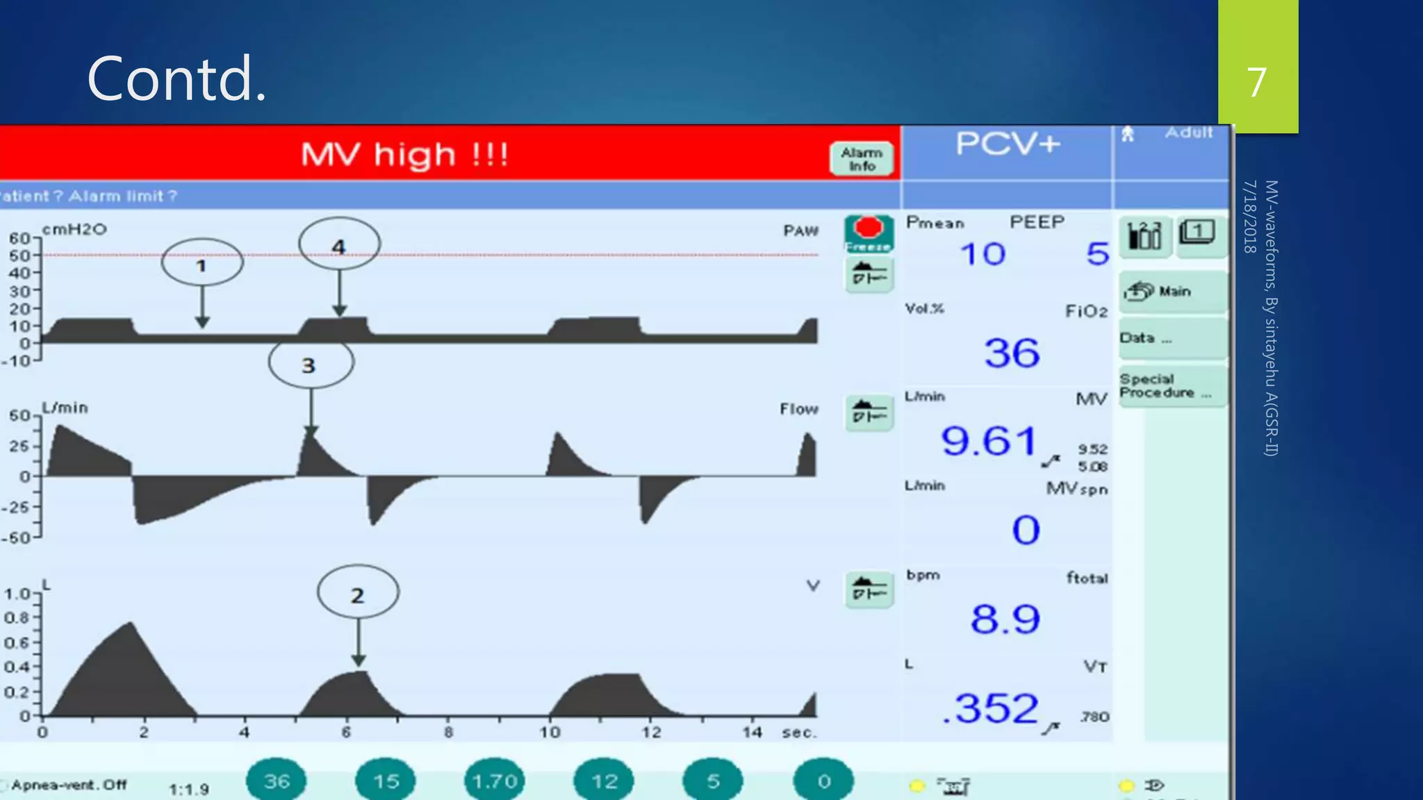 Contd.
 Most ventilators can operate as a volume controller or pressure controller
 As a volume controller:
 The ventilator can deliver a mechanical breath with a constant volume pattern
 Only pressure varies according to the dynamic characteristic of the respiratory
system
 As a pressure controller:
 The ventilator delivers mechanical ventilation with a constant pressure pattern
 Both flow and volume vary according to the dynamic characteristic of the
respiratory system.
7
 