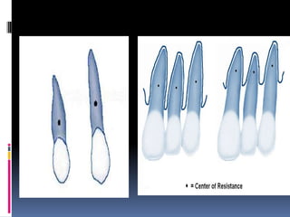Teeth Mechanic Mechanics of tooth movement | PPTX
