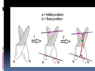 Mechanics of tooth movement | PPTX