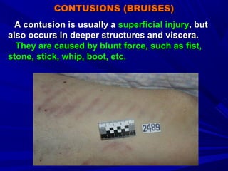Mechan injuries 17-18сжат-1;zsmu | PPT
