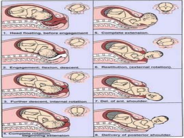 mechanism-of-labour.ppt OBSTETRICS and gynaecologist | PPT