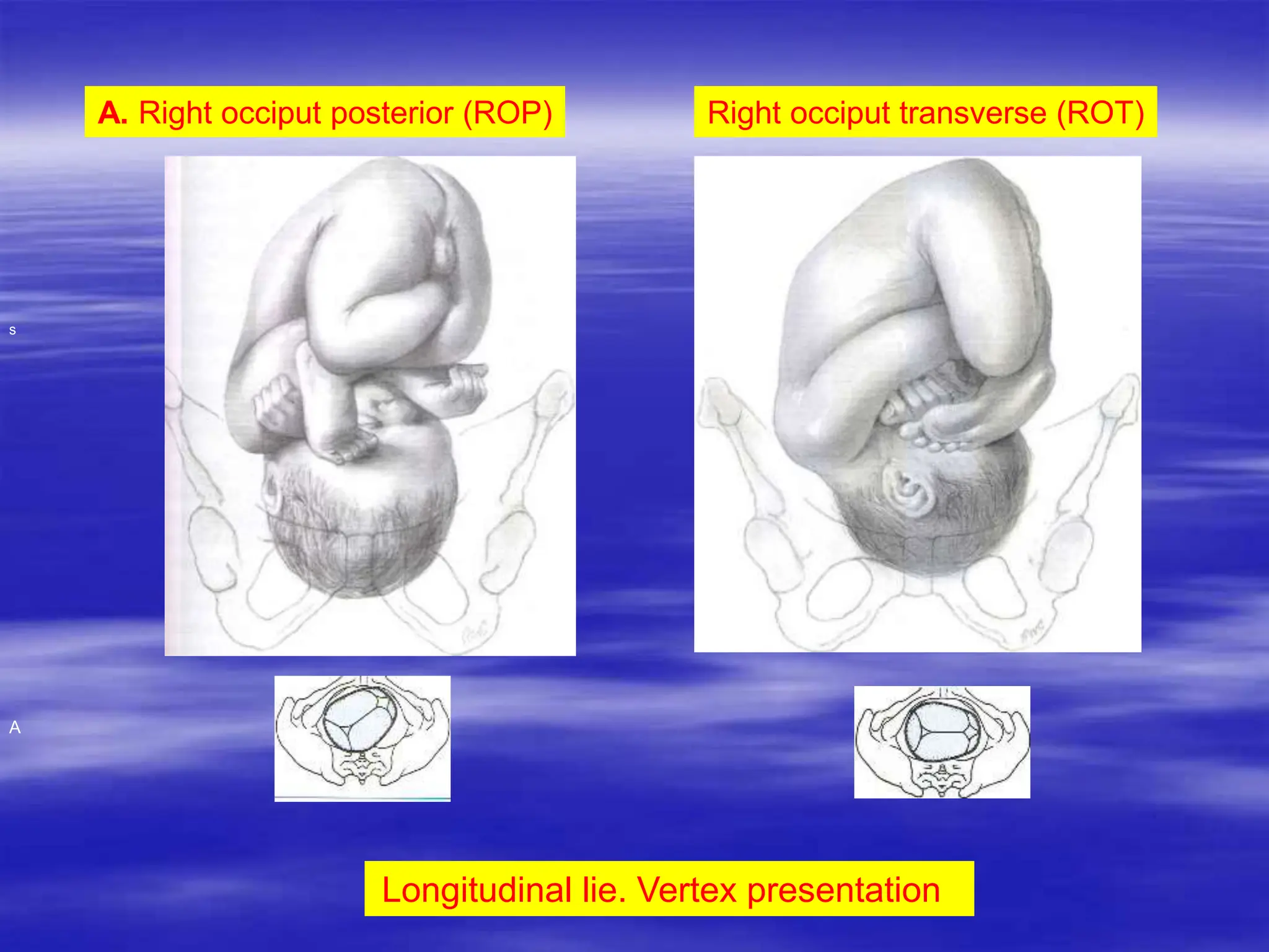 Mechanism of labour normal and abnormal ppt