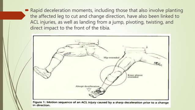 Mechanism of ACL InjURY | PPTX | Death, Injury, or Military Conflict ...