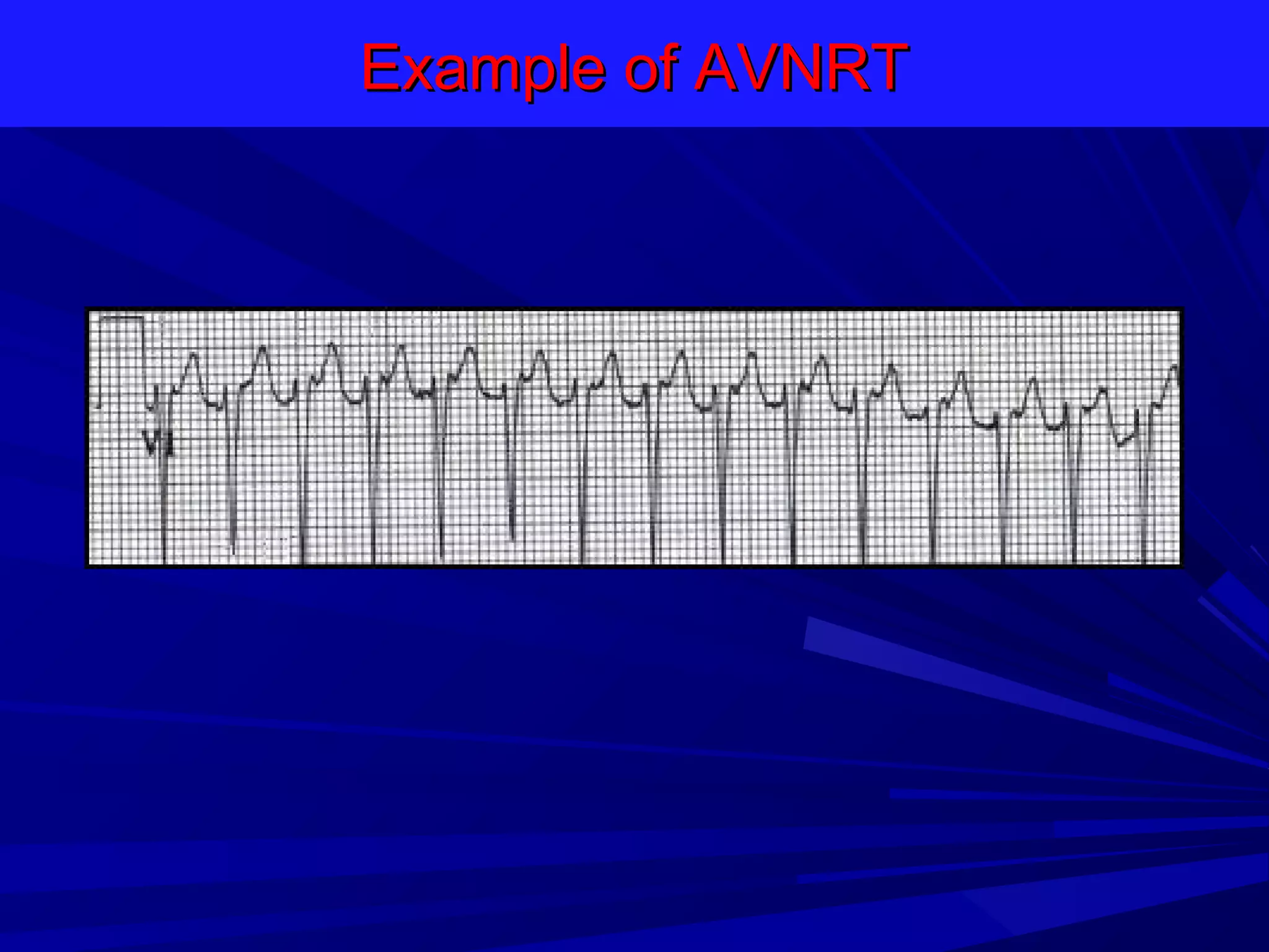 Example of AVNRT

 