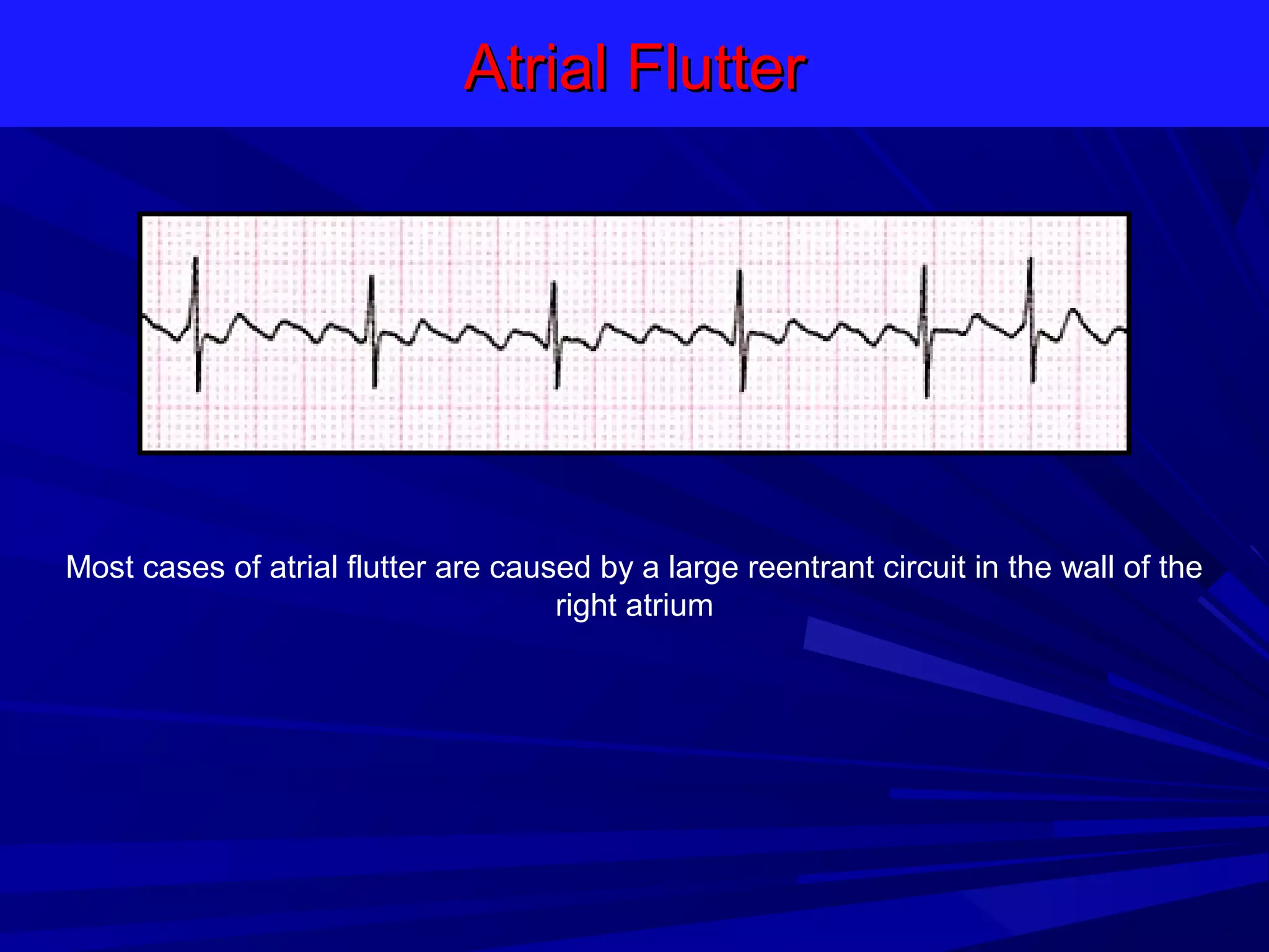 Atrial Flutter

Most cases of atrial flutter are caused by a large reentrant circuit in the wall of the
right atrium

 