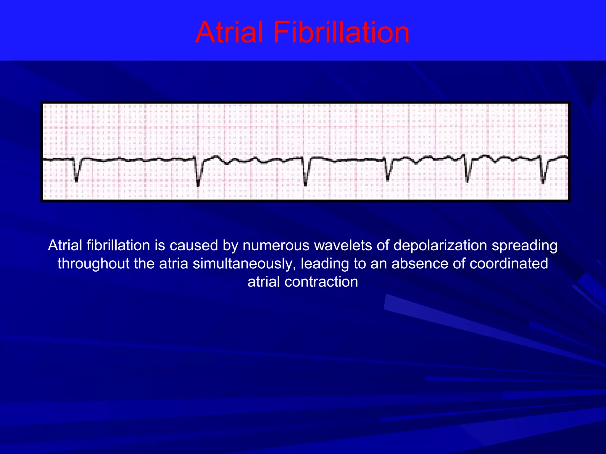 Atrial Fibrillation

Atrial fibrillation is caused by numerous wavelets of depolarization spreading
throughout the atria simultaneously, leading to an absence of coordinated
atrial contraction

 